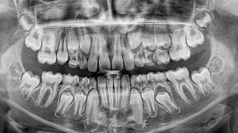 Hvordan at skelne en baby tand fra deres oprindelige funktioner