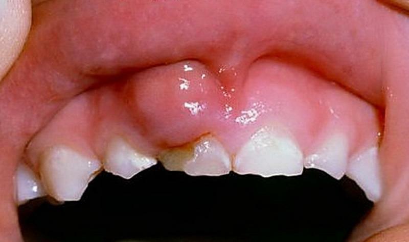 טיפול חניכיים שיניים נשירים אצל ילדים
