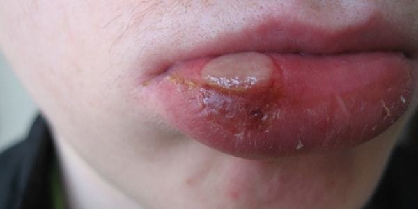 Syphilis on the lip: the causes of formation and what the chancre looks like at different stages of the disease