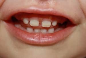 Mléčných zubů u dětí, kousací schéma