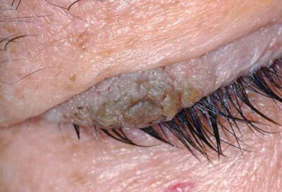 Papiloma maligno - causas de la formación