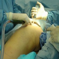 Plastische Chirurgie: Liposuctie