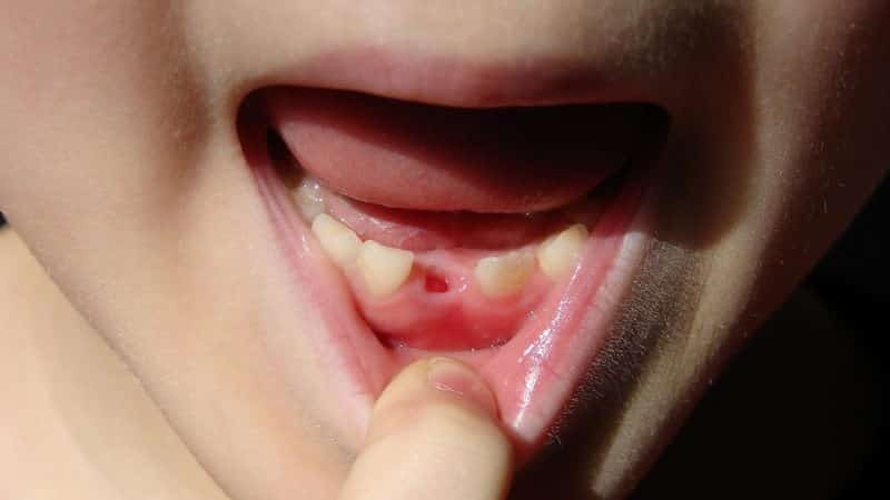 co dělat s padlých zuby mléčné