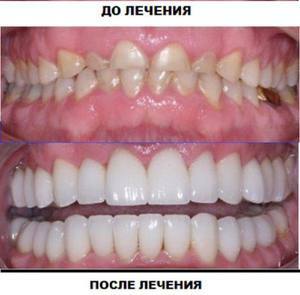 Индикације зуби Капацитет