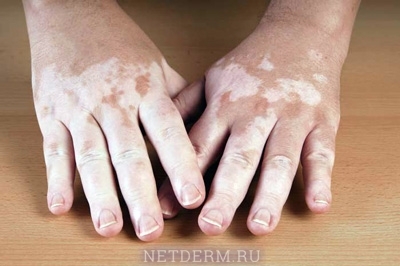 Vitiligo på hænderne