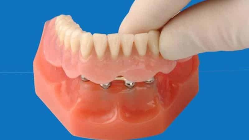 Hambaproteesid: liiki eemaldatav proteesimine