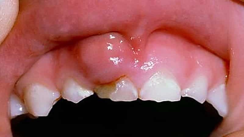 inflamación de las encías y dolores de dientes que hacen