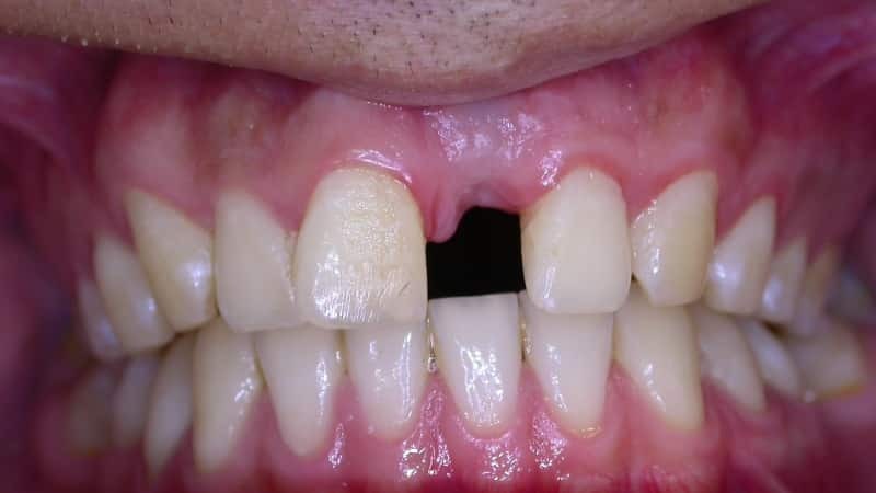 implantatie van voorste tanden voor en na foto
