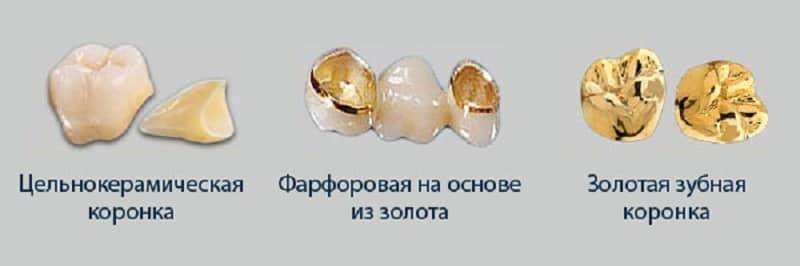 Ko labāk likt kronām uz priekšējiem zobiem, košļājamās un pamatiedzīvotāju