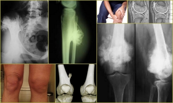 Osteochondrom: Ursachen, Symptome, Diagnose, Behandlung