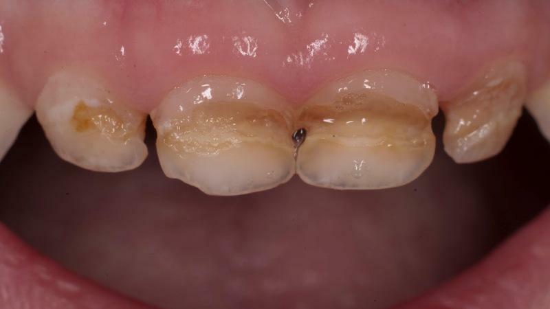 dientes del cepillo de silicona