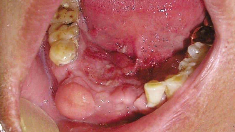 Krebs des Zahnfleischs - Anfangsstadium: das Foto und Symptome