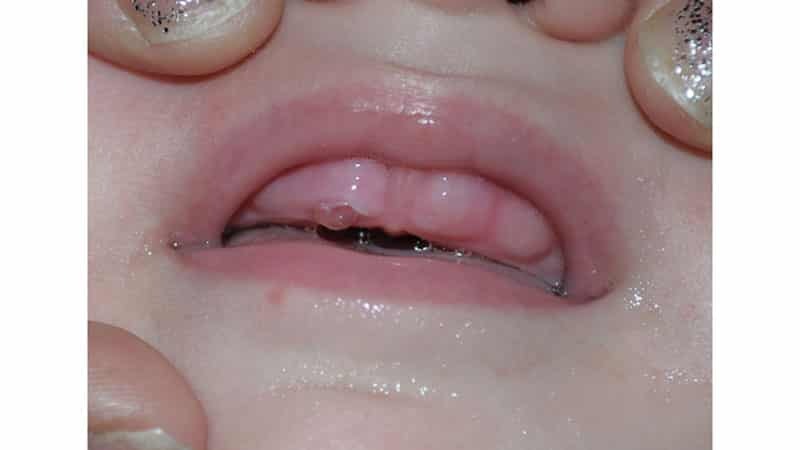 Zuba djeteta
