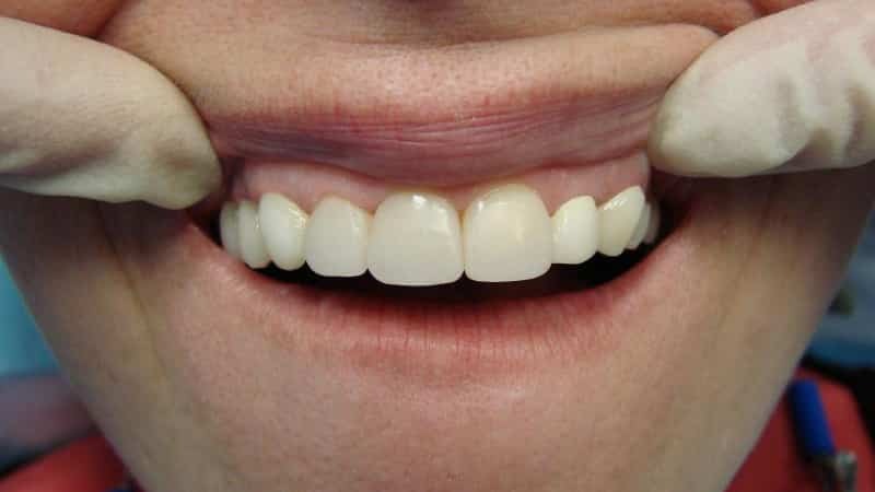 Restauro di denti: una foto prima e dopo il restauro