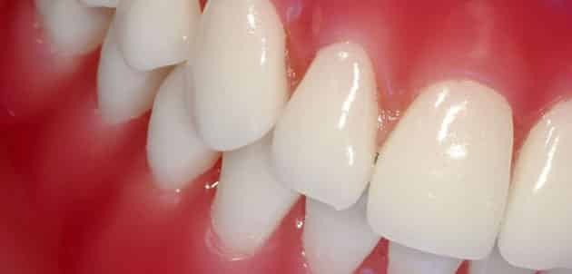Symptomer og behandling af tandkødsbetændelse, foto sygdomme