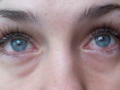 Hornhauttrauma Augenbehandlung