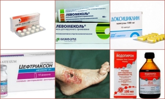 Antibióticos para las úlceras tróficas de las extremidades inferiores