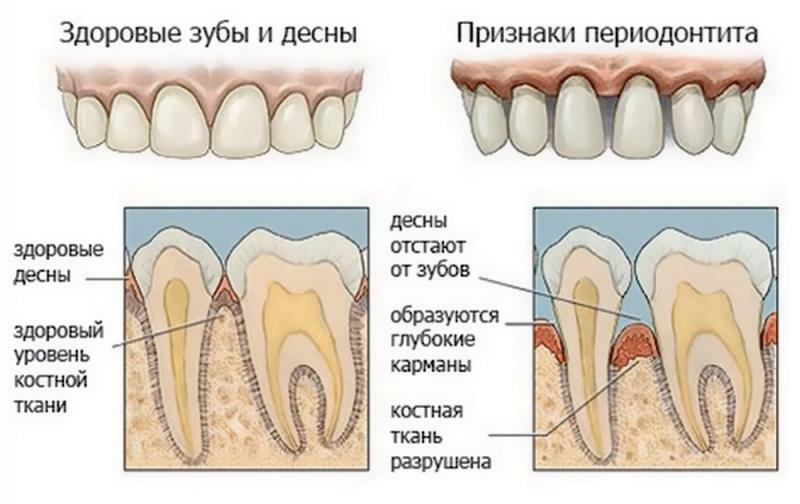 tratamiento de la periodontitis en los niños