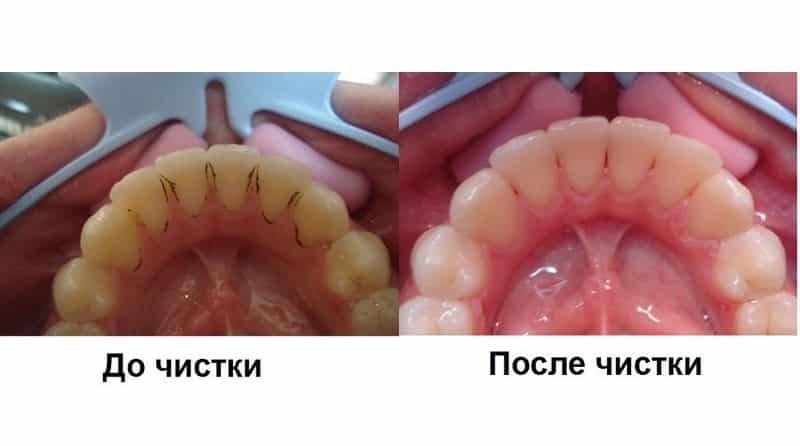 Ultraschallreinigung der Zähne, dass es