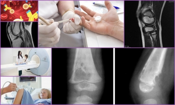 Die Diagnose der Osteomyelitis bei Kindern