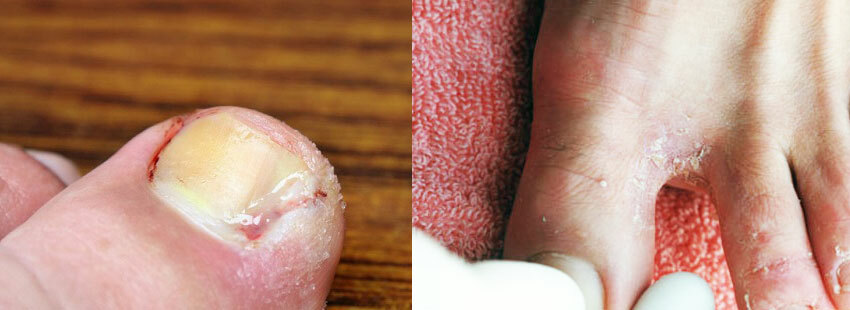 Fundizol de hongos de uñas en las piernas - opiniones sobre el tratamiento y las instrucciones de uso