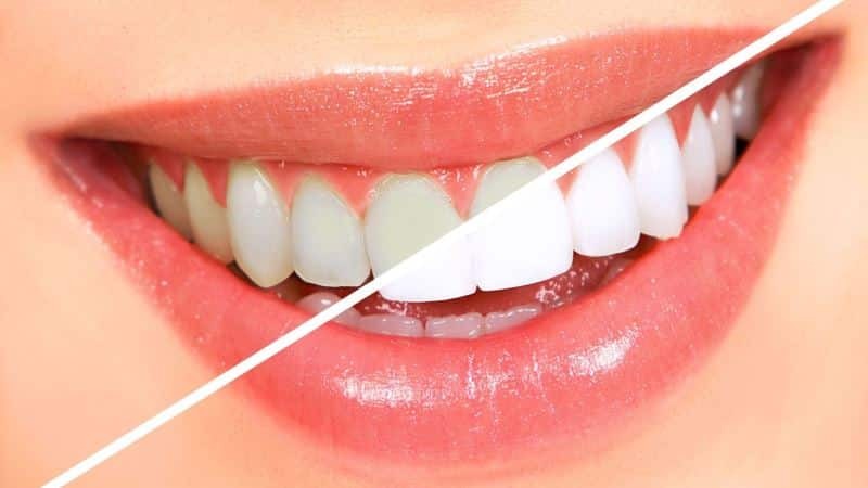 et blegemiddel for tænderne