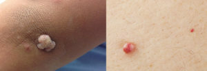 How to distinguish a wart from a papilloma