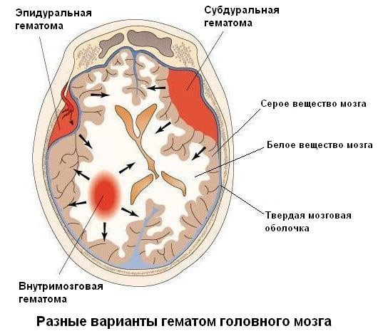 Como tratar o hematoma na cabeça após uma hematoma
