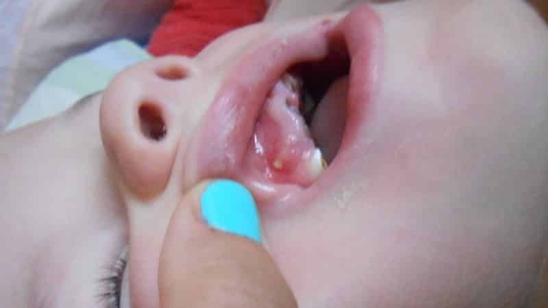 eitrige Tasche auf dem Zahnfleisch des Kindes