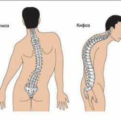 Kifoz de la columna vertebral - ¿qué es peligroso y cómo tratarlo?
