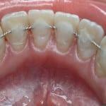 Anpassningen av tänderna hemma hängslen