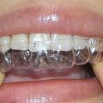 Korrektur Zähne ohne Klammern bei erwachsenen Foto