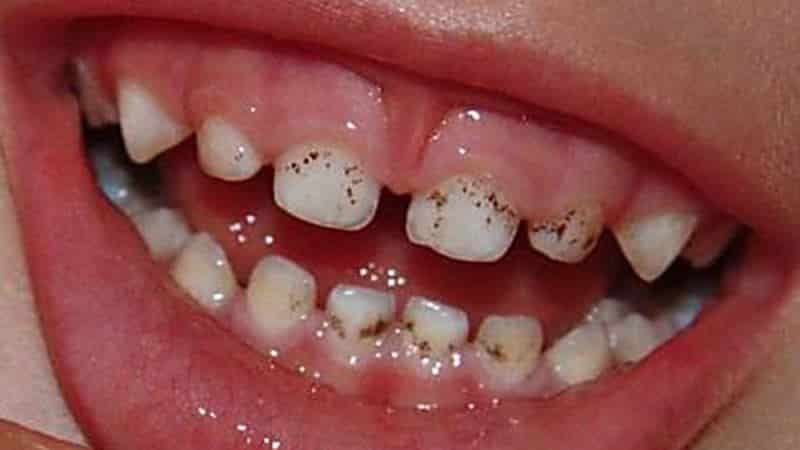 hvorfor der er en sort mindeplade på barnets tænder at slippe