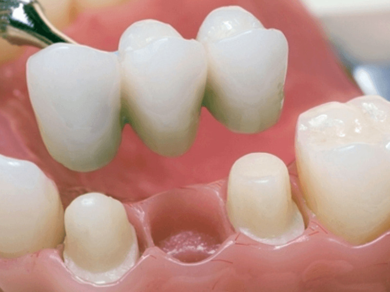 Metal-ceramic teeth