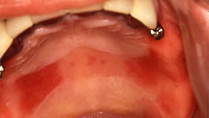 Jak bělení zubní protézu z plastu doma
