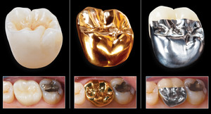 Charakteristische Arten Zahnkronen