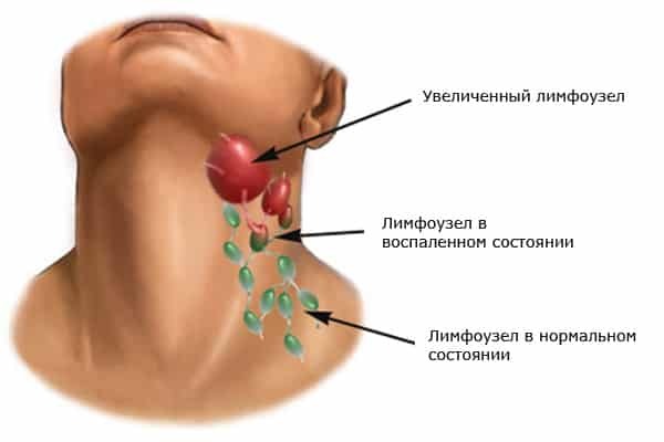 hva du skal gjøre hvis hovne sår forstørret submandibular lymfeknute i halsen under kjeven fra venstre til høyre som kur