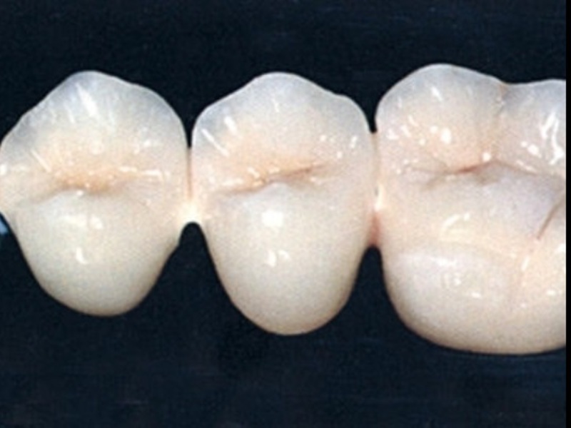 Osittaista tai täydellistä hammasproteesit