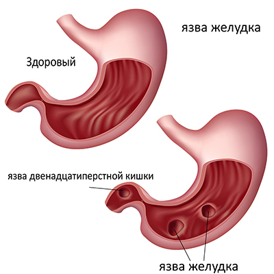 Is it possible to treat medications with stomach and duodenal ulcers?