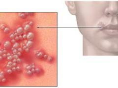 Herpes på läpparna