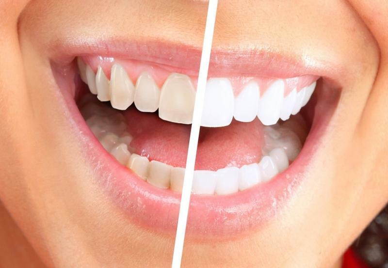 Ist Teeth Whitening schädlich