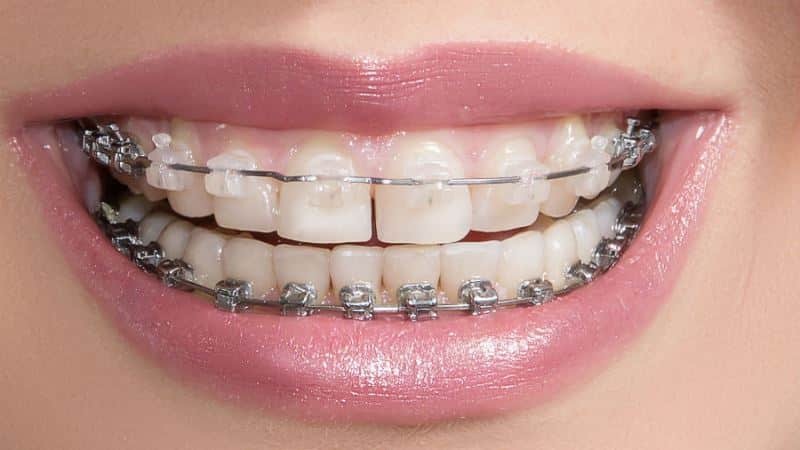 se o dentista pode extrair dentes
