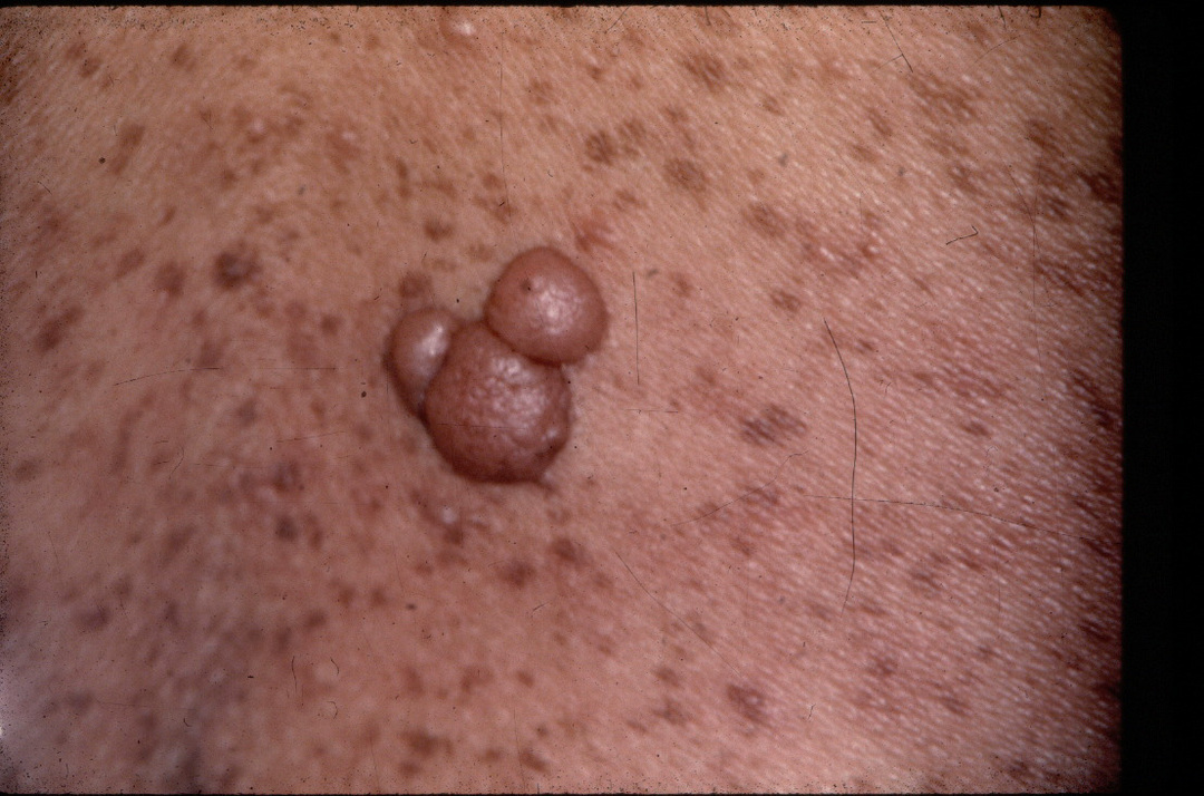 Gutartige Hauttumoren: Arten von Risiken und Wiedergeburt