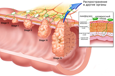Cuatro estadios del cáncer de estómago
