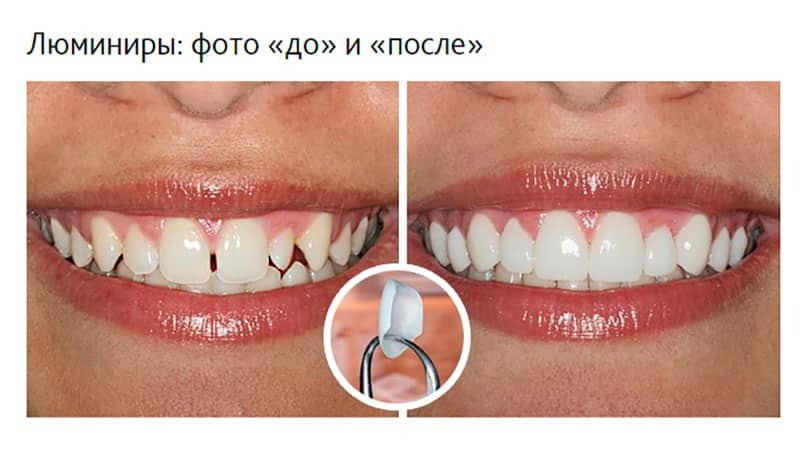 Installasjon av de keramiske platene på tennene