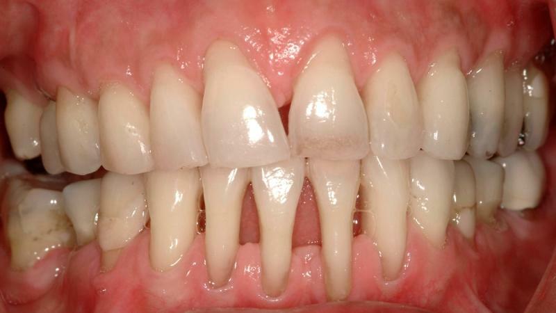 Auslassung Zahnfleischbehandlung
