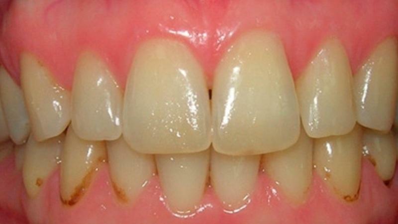 Arten von Zahnaufhellung
