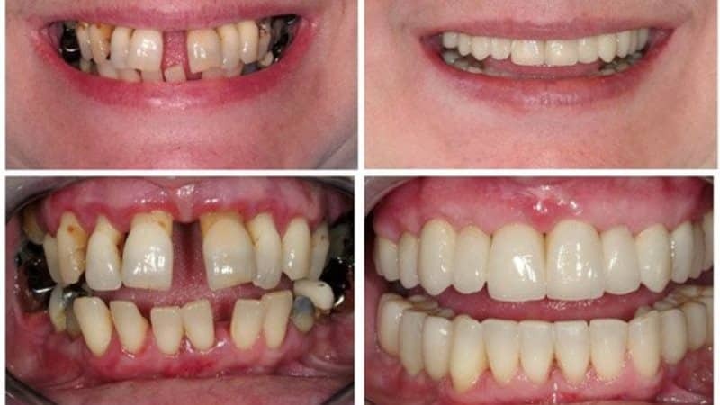 Prothese met parodontitis en parodontitis: een implantatie beoordelingen