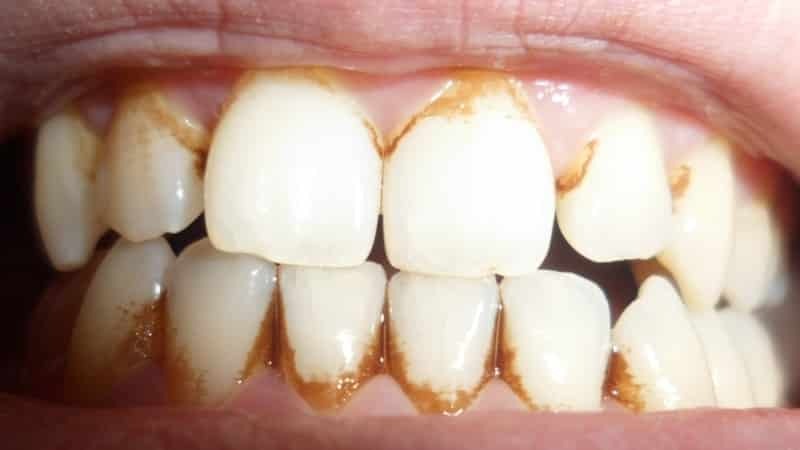 wie Plaque von den Zähnen entfernen