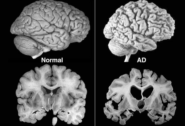 Symptomy a léčba atrofie mozku